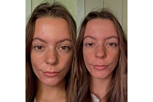 There’s no need to cover acne-prone skin to make it look beautiful – three testers try out a new Nordic no cover no colour foundation primer with stunning results