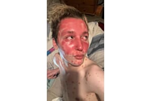 Dermal fillers triggered TV presenter’s aggressive psoriasis   
