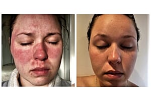 Mum-to-be with rosacea couldn’t look in the mirror until Kalme rescued her ravaged red skin