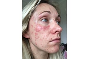 Could weight loss jabs also work for improving psoriasis?