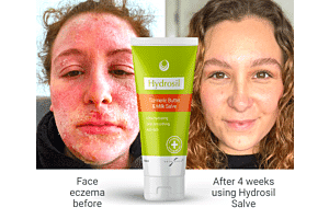 Young mum with TSWS finds best natural cream for eczema containing plant-steroid and donkey milk clears skin in weeks