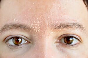 Is skin microdosing the key to managing eczema?