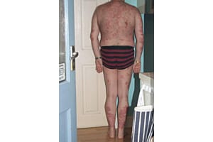 Women refused to even meet chef with 80% psoriasis until a plant root serum rescued his skin and now he's getting married