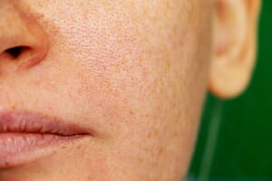4 causes of open pores and how to minimise them