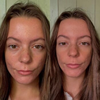 There’s no need to cover acne-prone skin to make it look beautiful – three testers try out a new Nordic no cover no colour foundation primer with stunning results