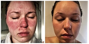 Mum-to-be with rosacea couldn’t look in the mirror until Kalme rescued her ravaged red skin
