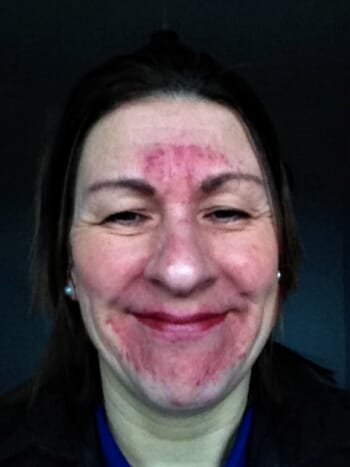 Bullied police officer's stressed-triggered skin was transformed with best rosacea cream