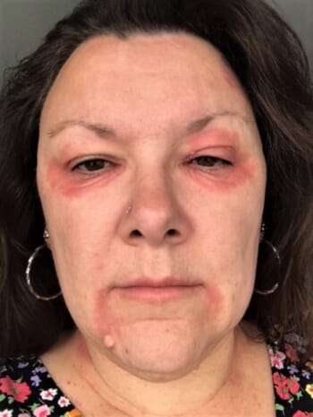 Is menopausal blepharitis common? 4 women share their experiences & relief at finding best cream for menopausal eye eczema