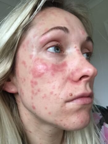 Could weight loss jabs also work for improving psoriasis?