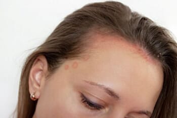 6 reasons why scalp psoriasis keeps coming back
