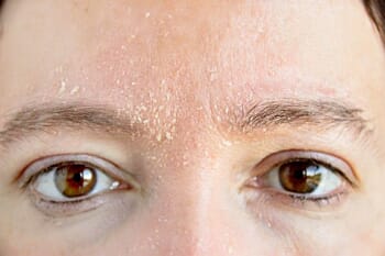 Is skin microdosing the key to managing eczema?
