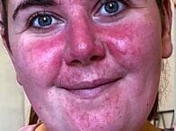 Young mum with rosacea misses out on family photos until she discovers best cream for rosacea 