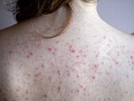 6 ways to wage war on winter Bacne