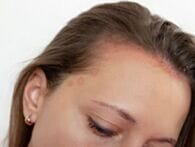 6 reasons why scalp psoriasis keeps coming back