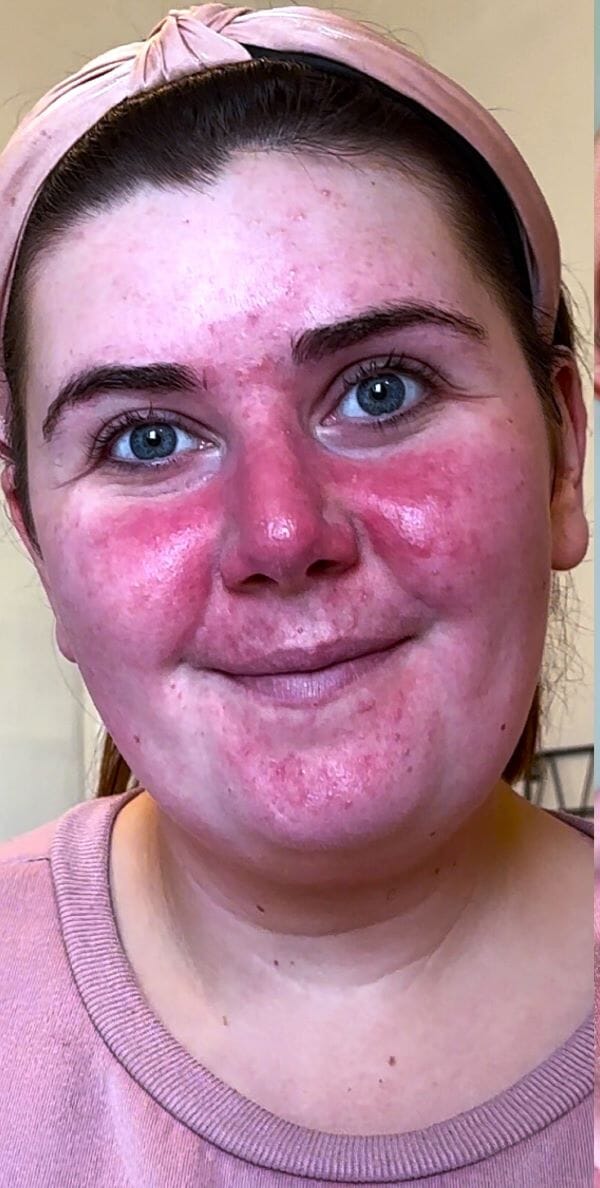 Young mum with rosacea misses out on family photos until she discovers best cream for rosacea 