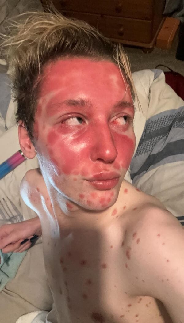 Dermal fillers triggered TV presenter’s aggressive psoriasis   