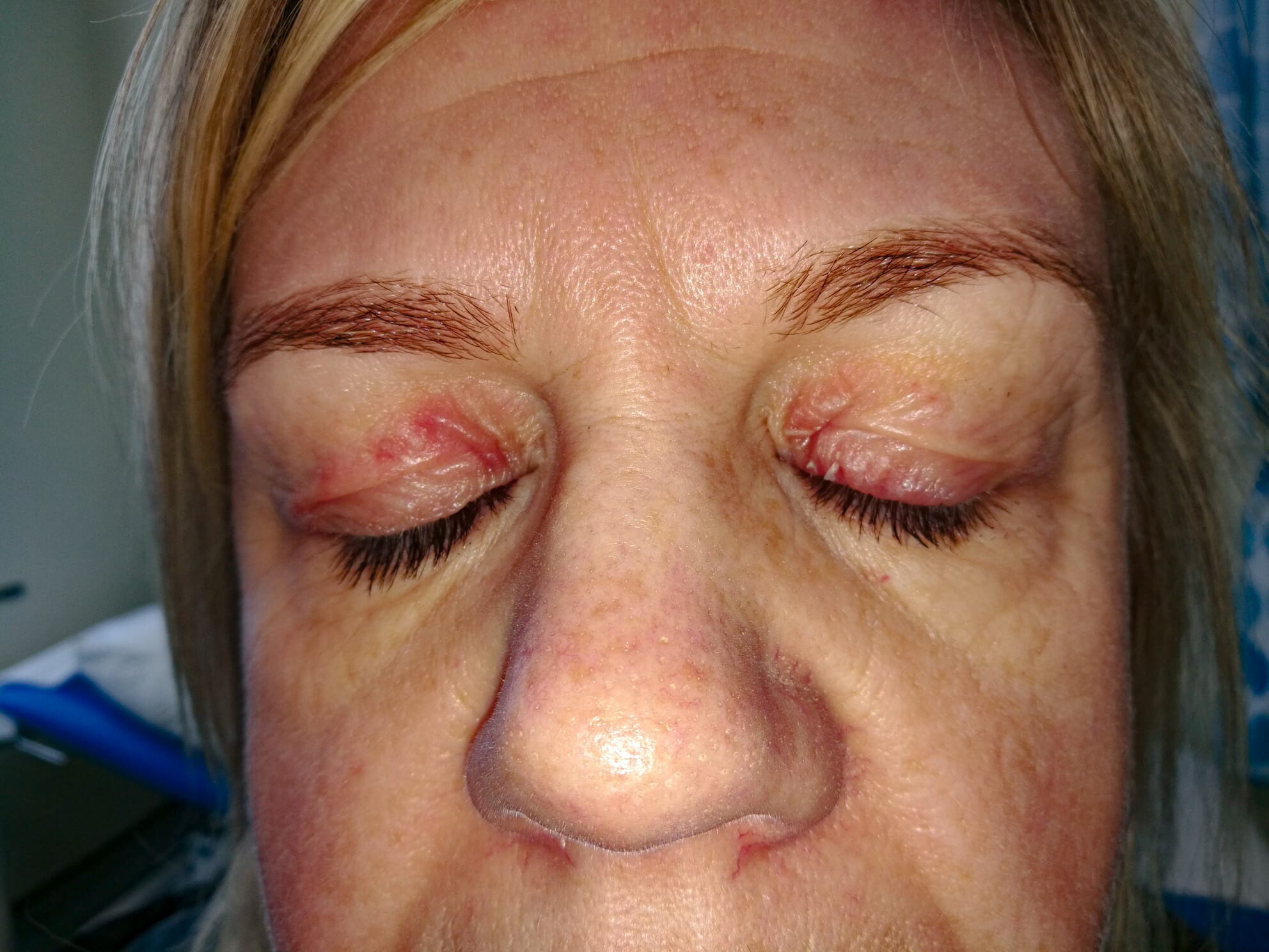 eczema-eyelids