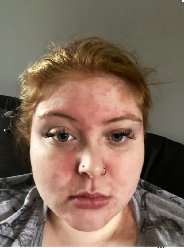 Young woman's psoriasis was triggered by childhood abuse but best psoriasis shampoo cleared her face in three washes 