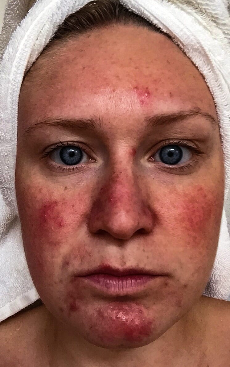 Woman Diagnosed With Acne Actually Had Rosacea And The Medications Made
