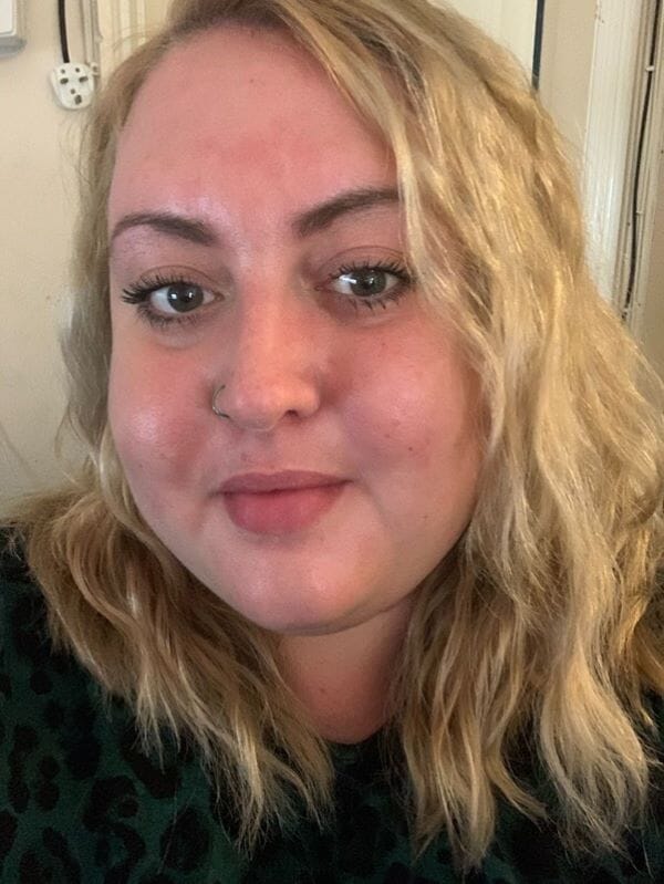 Young mum skin shamed about her psoriasis