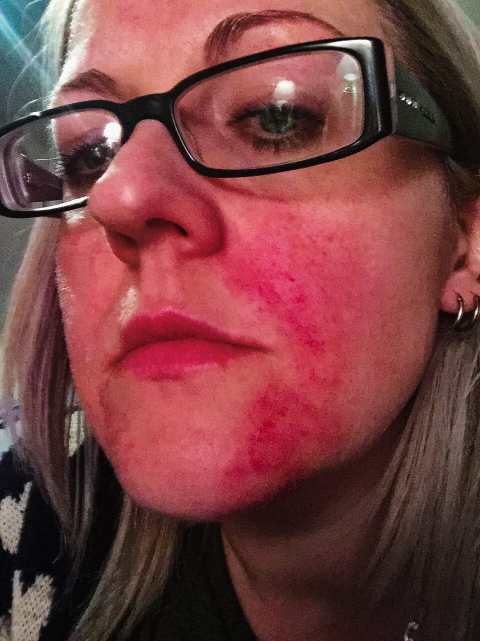 Heartbreak caused one woman's rosacea ravaged skin until Kalme came to the rescue
