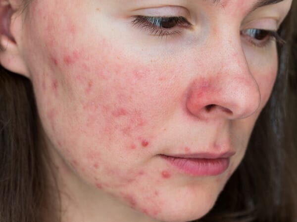 Adult acne affects 1 in 4 women & these two sufferers have discovered the best adult acne cream