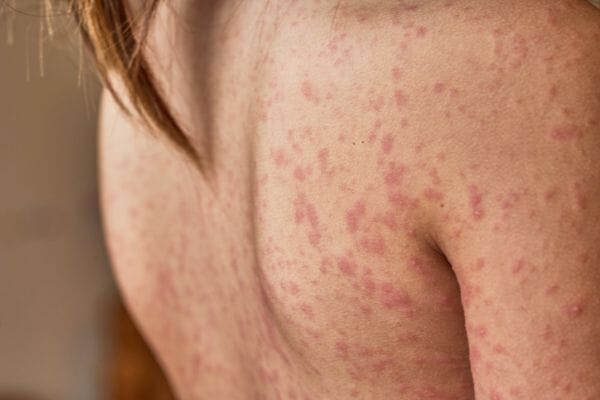 New study discovers why some people with psoriasis also develop psoriatic arthritis