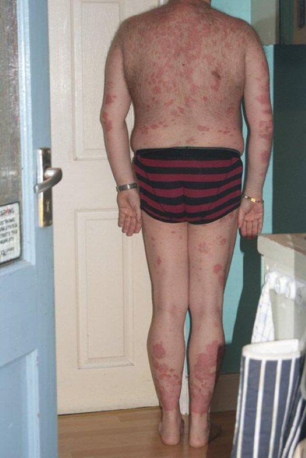Women refused to even meet chef with 80% psoriasis until a plant root cream rescued his skin and now he's getting married