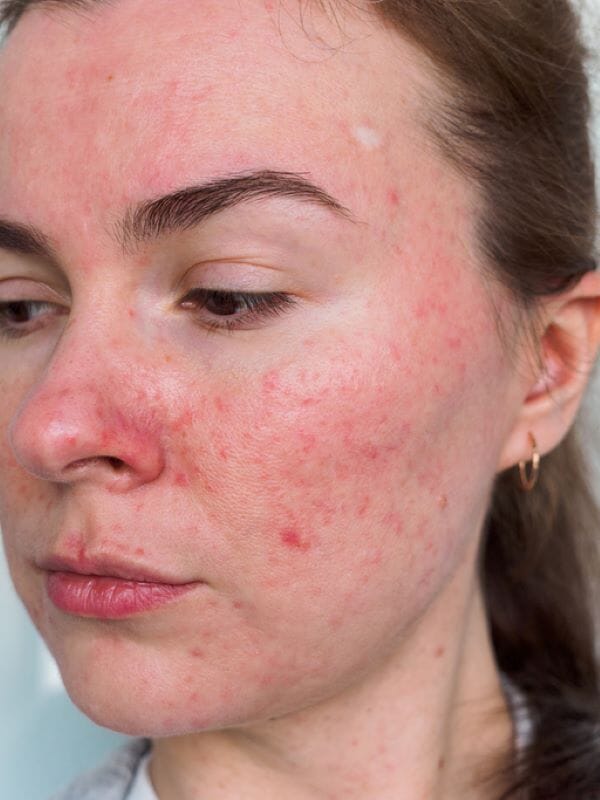 4-causes-of-perimenopausal-acne-and-how-to-tackle-them