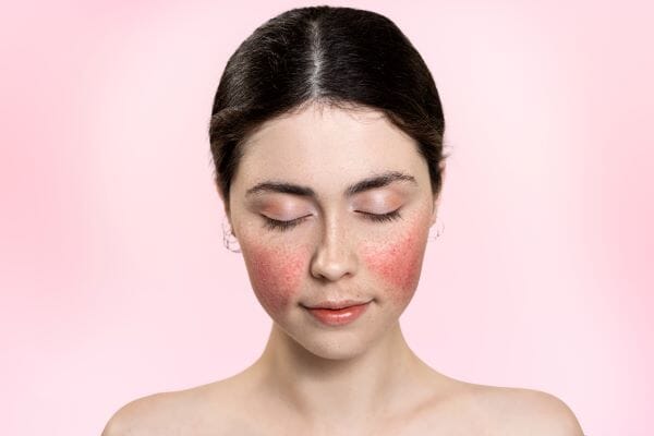 6 common health conditions linked to rosacea
