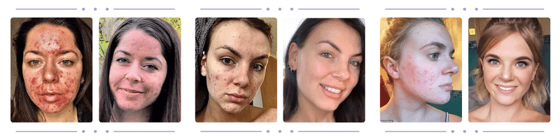 Before and After Kalme Skin Care Routine