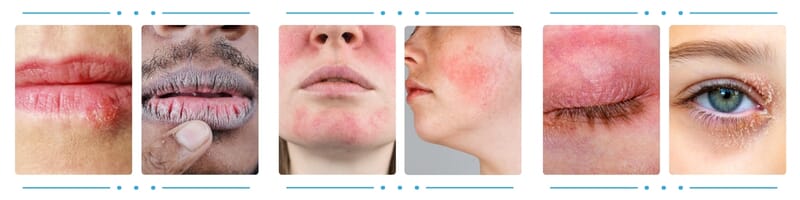 Before and After Kalme Skin Care Routine