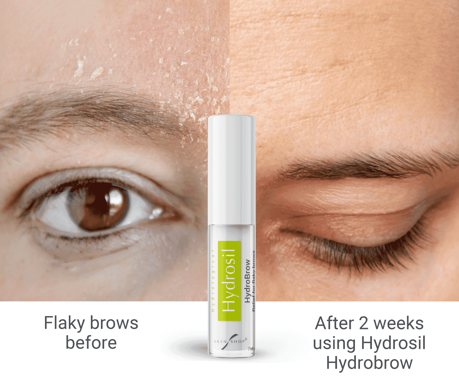 Solution for eyebrow eczema and flaky eyebrows