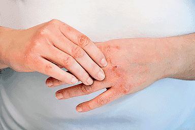 6 Ways To Heal Dry Hands From Overwashing